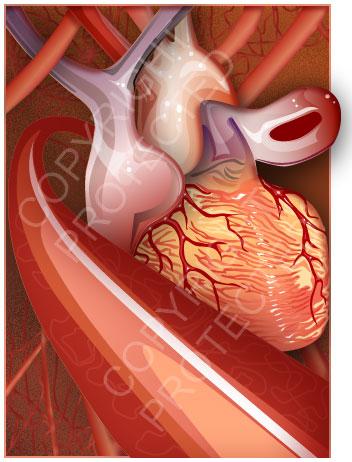 Cartoon: Medical Illustration (medium) by remyfrancis tagged medical,heart,vector,drawing,coronary,illustration